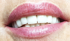 Poslije Pflumm Cirkon